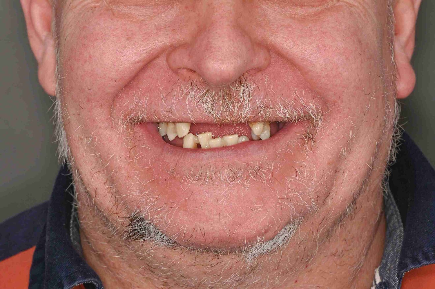 Pacient Clinica Dr. Alin Odor - Rezultat Implantologie